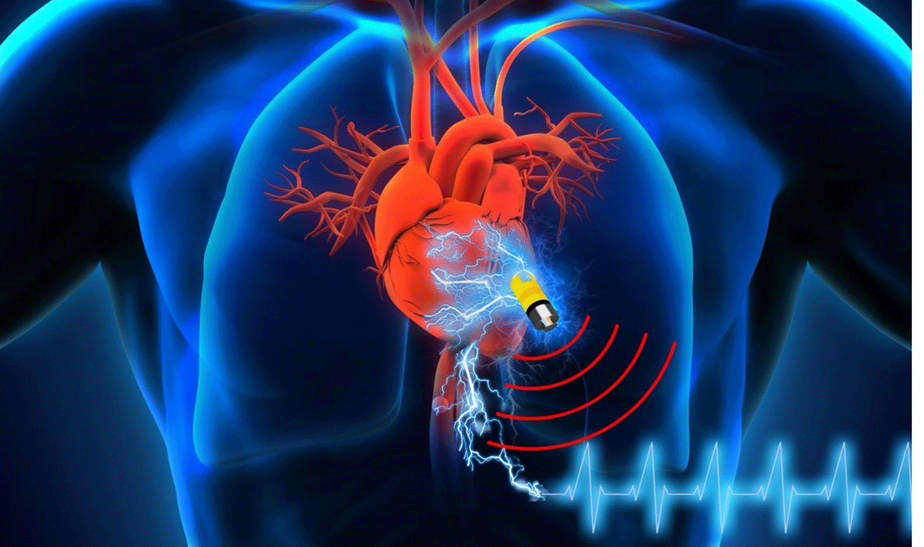 Powerelectronics 5750 Pacemakerbatt Promo