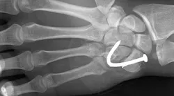 PROMOdeck_hand-X-ray_Wikimedia.png