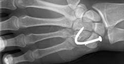 PROMOdeck_hand-X-ray_Wikimedia.png PROMOdeck_hand-X-ray_Wikimedia.png