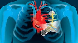 Piezo-Based Energy Harvesting for Medical Implants May Transcend Alternative Approaches Piezo-Based Energy Harvesting for Medical Implants May Transcend Alternative Approaches