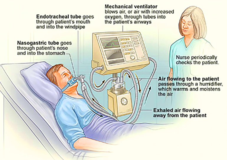 1. How a ventilator works. (Source: National Heart, Lung and Blood Institute).