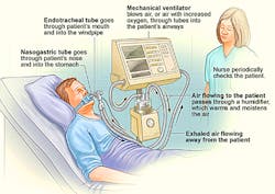 1. How a ventilator works. (Source: National Heart, Lung and Blood Institute).