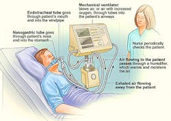 1. How a ventilator works. (Source: National Heart, Lung and Blood Institute). 1. How a ventilator works. (Source: National Heart, Lung and Blood Institute).