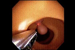 6. The next step involved pre-clinical-trial testing on simulated lesions in an artificial colon. (Source: Wyss Institute/Harvard University) 6. The next step involved pre-clinical-trial testing on simulated lesions in an artificial colon. (Source: Wyss Institute/Harvard University)