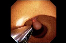 6. The next step involved pre-clinical-trial testing on simulated lesions in an artificial colon. (Source: Wyss Institute/Harvard University) 6. The next step involved pre-clinical-trial testing on simulated lesions in an artificial colon. (Source: Wyss Institute/Harvard University)