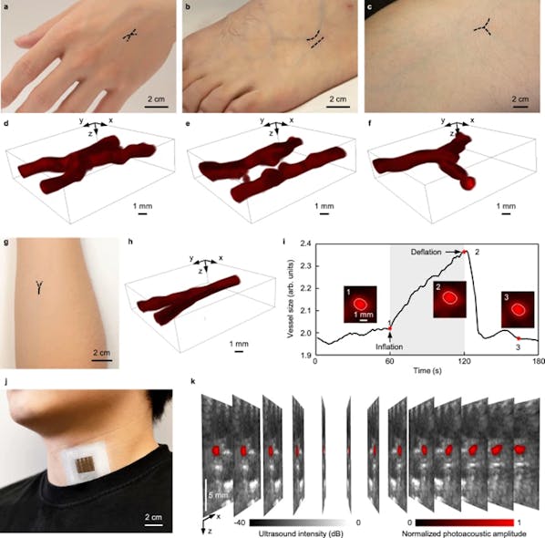 3. (a through h) Photos of the hand, foot, thigh, and forearm where the target veins are highlighted. The reconstructed 3D photoacoustic images are also shown. (i) Cross-sectional size changes of the vein before cuff inflation, during cuff inflation with a pressure of 70 mmHg, and cuff deflation. The pixels inside the white boundary with a value &gt;0.5 are counted to calculate the vein size. (j) A photograph of the patch attached to the human neck at a location above the internal jugular vein, or IJV. (k) 13 slices of dual-mode images acquired by the photoacoustic patch, i.e., photoacoustic images of the IJV superimposed on ultrasound B-mode images.