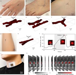 3. (a through h) Photos of the hand, foot, thigh, and forearm where the target veins are highlighted. The reconstructed 3D photoacoustic images are also shown. (i) Cross-sectional size changes of the vein before cuff inflation, during cuff inflation with a pressure of 70 mmHg, and cuff deflation. The pixels inside the white boundary with a value >0.5 are counted to calculate the vein size. (j) A photograph of the patch attached to the human neck at a location above the internal jugular vein, or IJV. (k) 13 slices of dual-mode images acquired by the photoacoustic patch, i.e., photoacoustic images of the IJV superimposed on ultrasound B-mode images. 3. (a through h) Photos of the hand, foot, thigh, and forearm where the target veins are highlighted. The reconstructed 3D photoacoustic images are also shown. (i) Cross-sectional size changes of the vein before cuff inflation, during cuff inflation with a pressure of 70 mmHg, and cuff deflation. The pixels inside the white boundary with a value >0.5 are counted to calculate the vein size. (j) A photograph of the patch attached to the human neck at a location above the internal jugular vein, or IJV. (k) 13 slices of dual-mode images acquired by the photoacoustic patch, i.e., photoacoustic images of the IJV superimposed on ultrasound B-mode images.